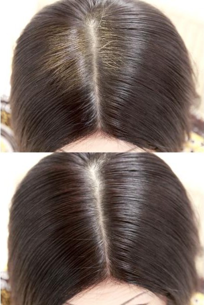 油性頭皮與健康頭皮對比