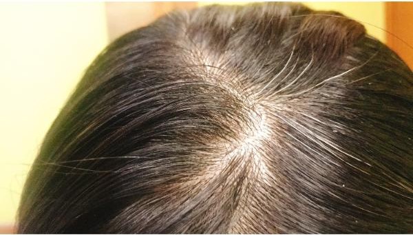 乾性頭皮與頭皮屑示意圖