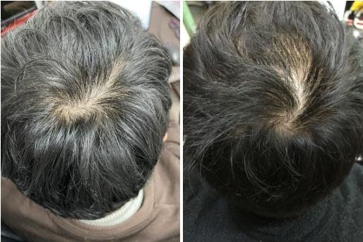 養髮液使用前後的頭皮變化