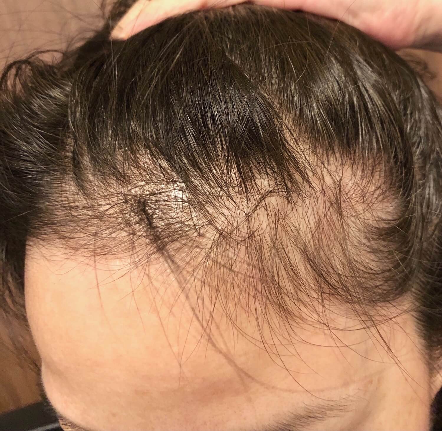 壓力導致掉髮與頭皮健康受損