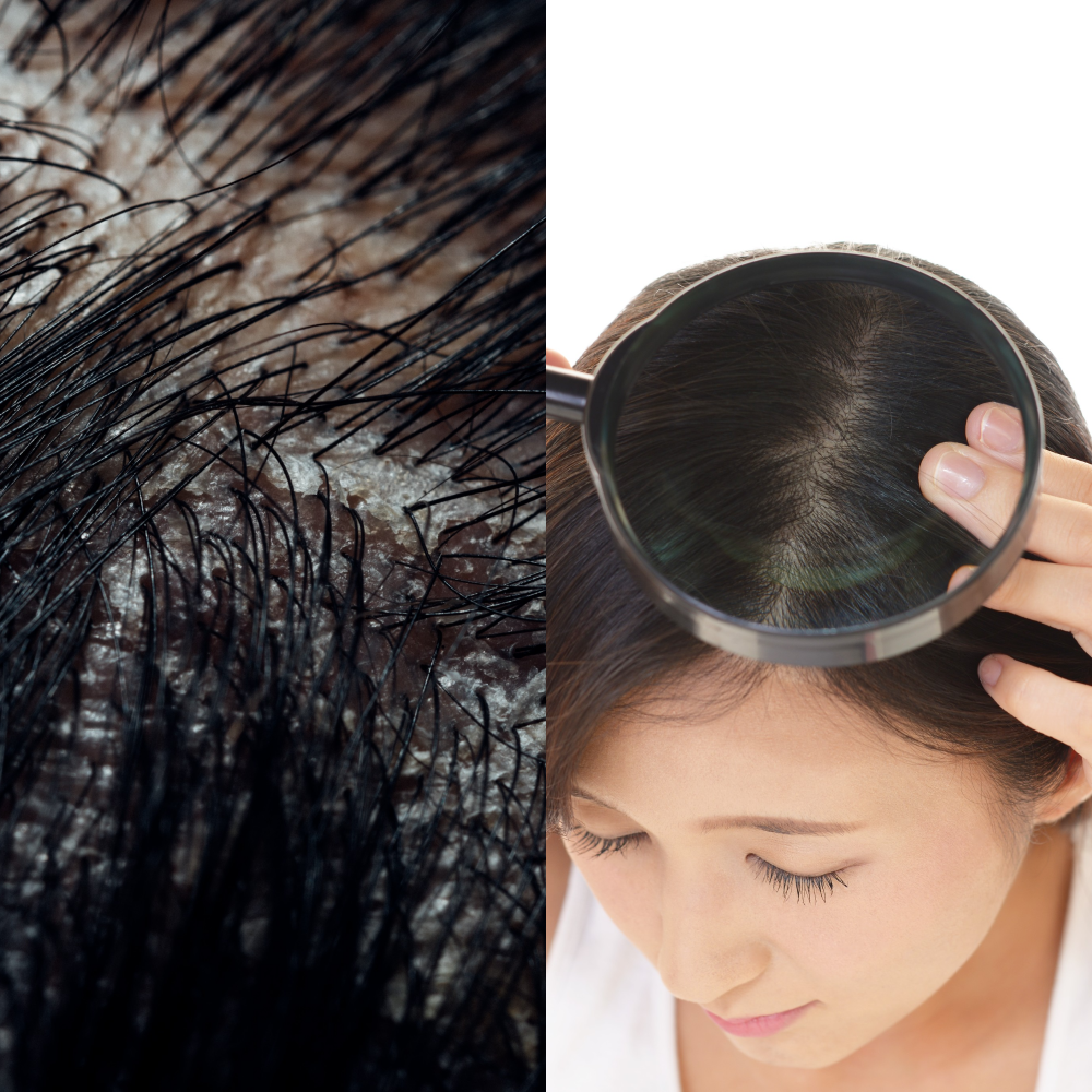 頭皮屑與健康頭皮檢測對比示意圖
